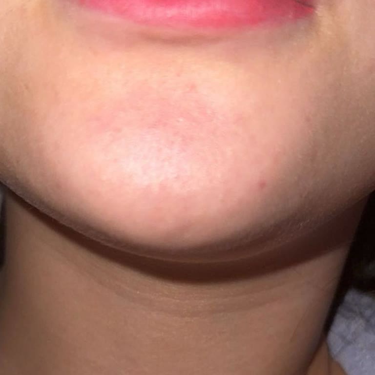 Bakırköy İlya Clinic Dudak Dolgu Eritme İşleminde Yaşadığım Mağduriyet