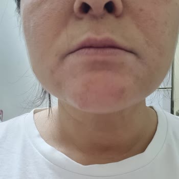 C Vitamini Serum Cildimde Yanma Ve Kabarma Yaptı, İade İstiyorum