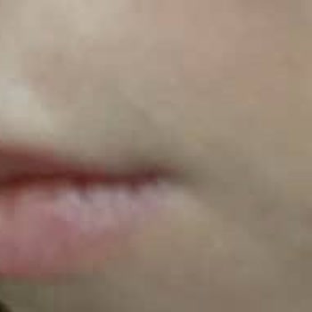 Dr. Tolunay Zeybekler Dolgu İşlemi Sonrası Ortaya Çıkan Şişlik