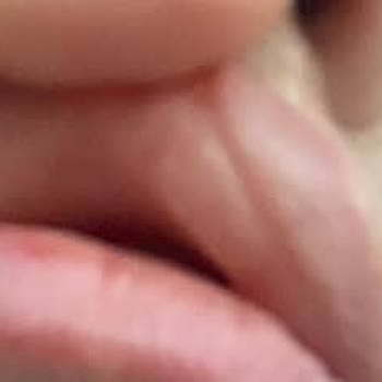 Dr. Tolunay Zeybekler Dolgu İşlemi Sonrası Ortaya Çıkan Şişlik