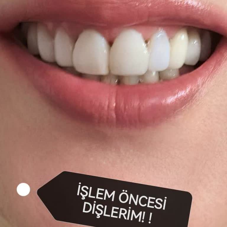 Dr. Engin Taviloğlu Fahiş Ücret Ve Ağrılı Kompozit Lamineler