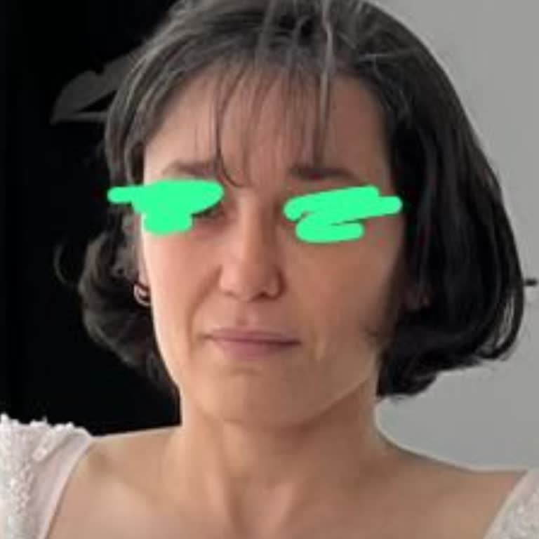 Revizyon Burun Ameliyatı Sonrası Hayal Kırıklığı Ve Güven Sorunu