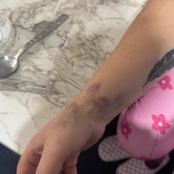 Ameliyat Sonrası Hemşirelerin Yetersizliği Ve İlgisizliği Nedeniyle Mağduriyet