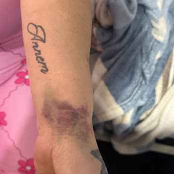 Ameliyat Sonrası Hemşirelerin Yetersizliği Ve İlgisizliği Nedeniyle Mağduriyet