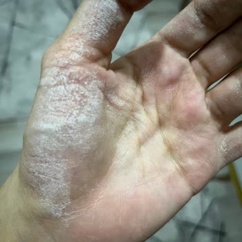 Domol Leke Çıkarıcı Sprey Elde Ciddi Yanma Yaptı