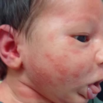 Bebelac 1 Mama Sonrası Bebeğimde Kızarıklık Ve Mağduriyet Yaşadık!