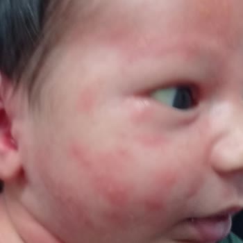 Bebelac 1 Mama Sonrası Bebeğimde Kızarıklık Ve Mağduriyet Yaşadık!