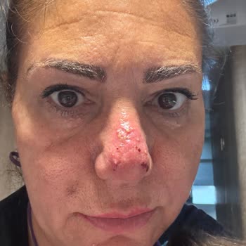 Yanlış Uygulama Sonucu Yüzümde Kalıcı Hasar Ve Maddi Mağduriyet