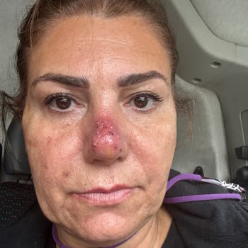 Yanlış Uygulama Sonucu Yüzümde Kalıcı Hasar Ve Maddi Mağduriyet