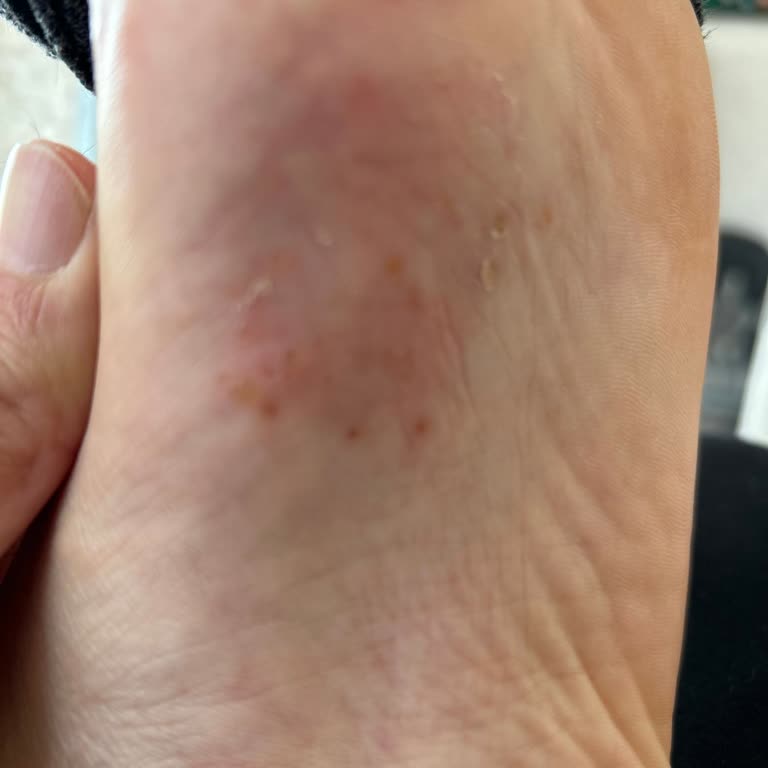 Skechers Ayakkabılar Ayağımı Yaraladı, Çözüm Sunulmadı!