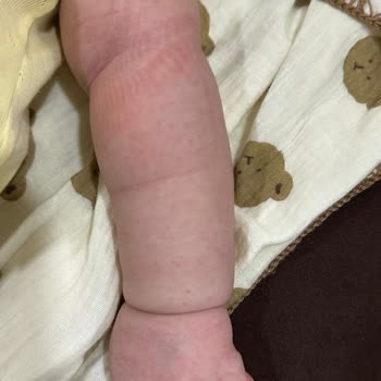 Medicana Sağlık Grubu Bebeğime Bilgim Ve Onayım Dışında Damar Yolu Açıldı, Yanıltıcı Bilgilendirme!