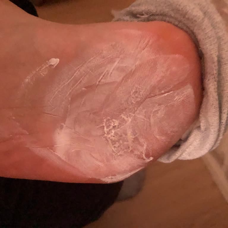 Adidas Galaxy6 Ayakkabı Ayaklarımda Yaralara Ve Nasıra Neden Oldu