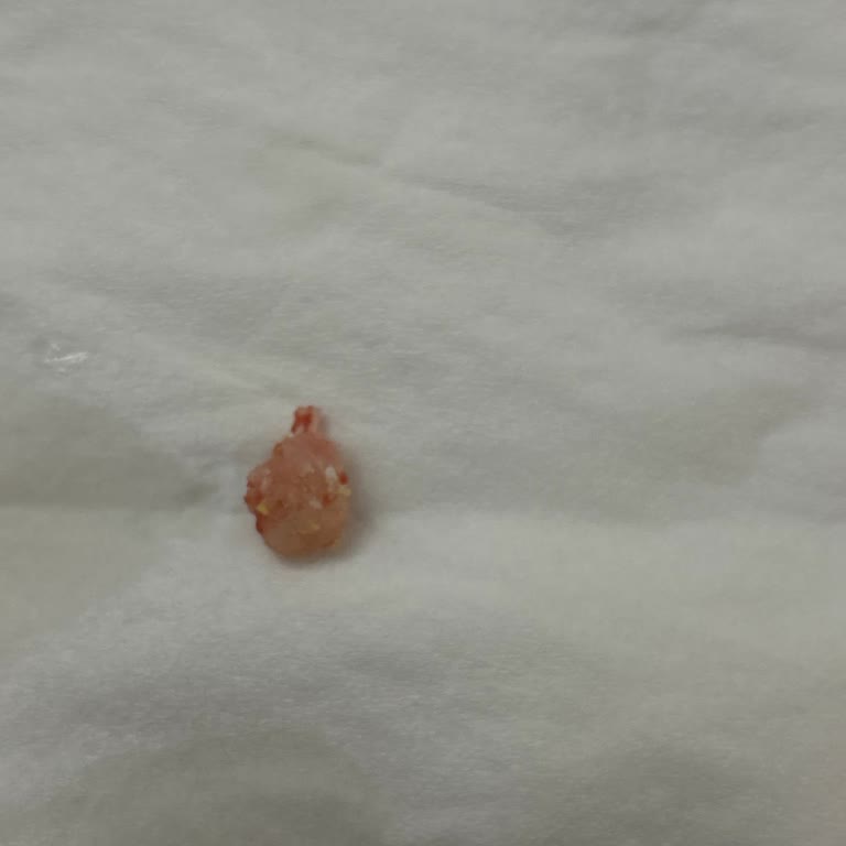 Beşler Sucuk Kasap Sucukta Kemik Parçaları: Sağlığım Tehlikeye Girdi!