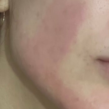 Bepantol Wound Gel Caused Burning and Swelling