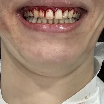 Lamine İşlem Sonrası Diş Aralıkları Kapatılmadı, Maddi Risk Bana Yüklendi