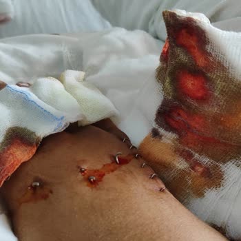 Trafik Kazası Sonrası Bilet İadesi Talebim Reddedildi, Mağduriyet Yaşıyorum