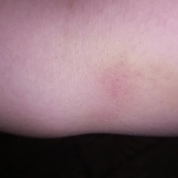 Dikkatsiz Hemşire Nedeniyle Kolumda Kalıcı Hasar Oluştu