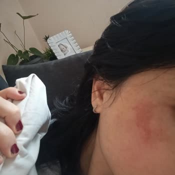 Lure Sir Ağda Bantları Yüzümde Ve Koltuk Altımda Yanık Oluşturdu, Mağduriyetimin Giderilmesini Talep Ediyorum