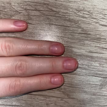 Jel Güçlendirme Sonrası Tırnaklarım Zarar Gördü, Geceleri Uyuyamıyorum