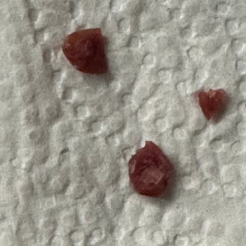 Reçelden Çıkan Sert Parça Dişimi Kırdı Mağduriyetim Giderilsin