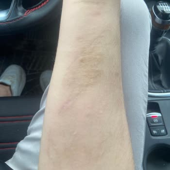 Yanlış Dövme Silme İşlemi Sonrası Kalıcı Yanık Ve Ücret İadesi Mağduriyeti