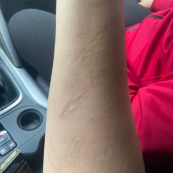 Yanlış Dövme Silme İşlemi Sonrası Kalıcı Yanık Ve Ücret İadesi Mağduriyeti