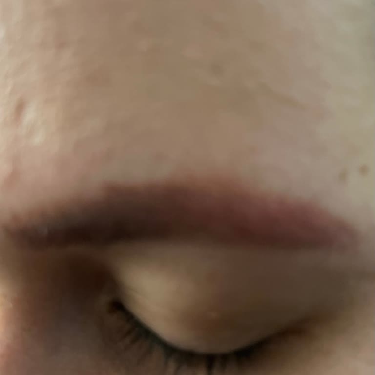 Kaş Silme İşlemi Sonrası Kalıcı Hasar Endişesi