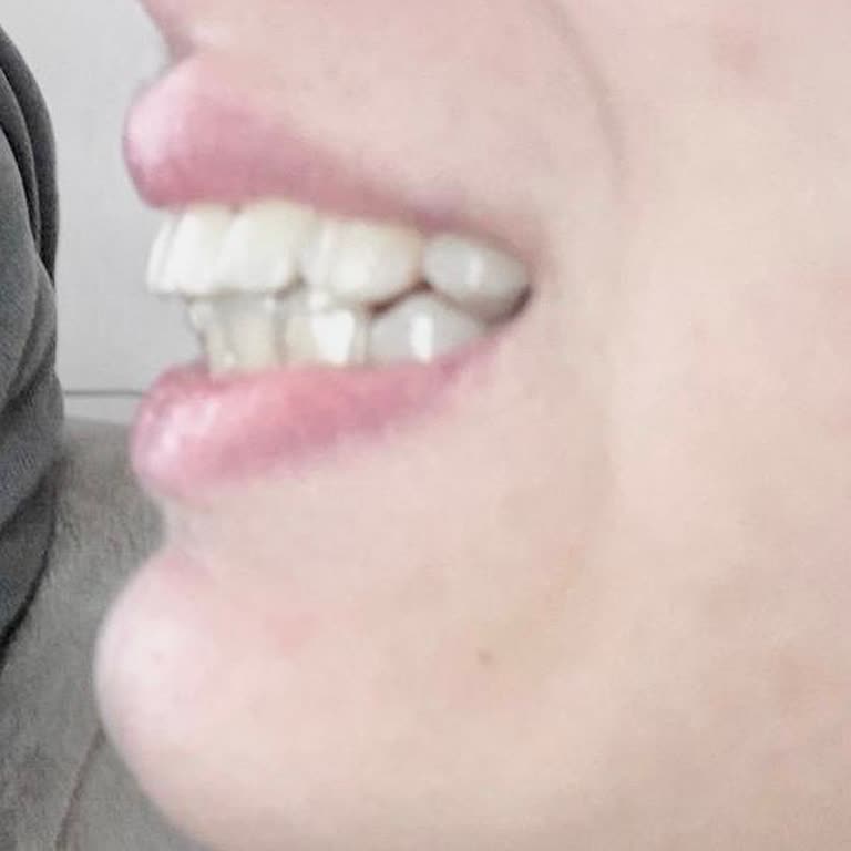 Dent Apical Dişler Hâlâ Düzelmiş Değil Ve Estetik Olarak Da Fonksiyon Olarak Da Memnun Değiliz