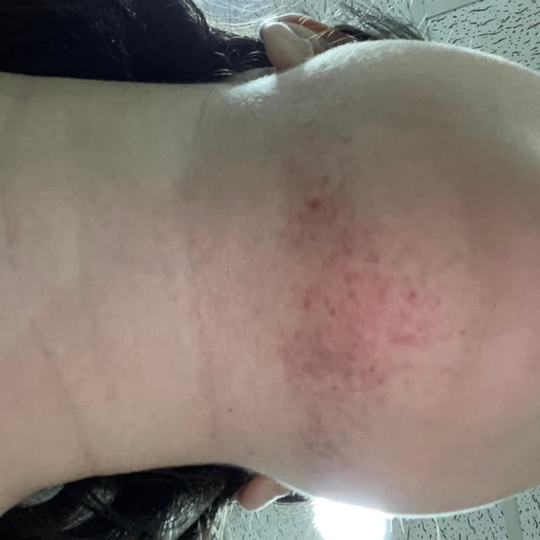 Sudem Beauty Center İlk Seansta Cildimde Tahriş Oldu