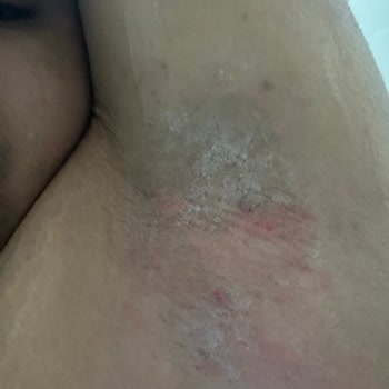 Veet Hair Removal Cream Caused Severe Burning After Use On Underarms