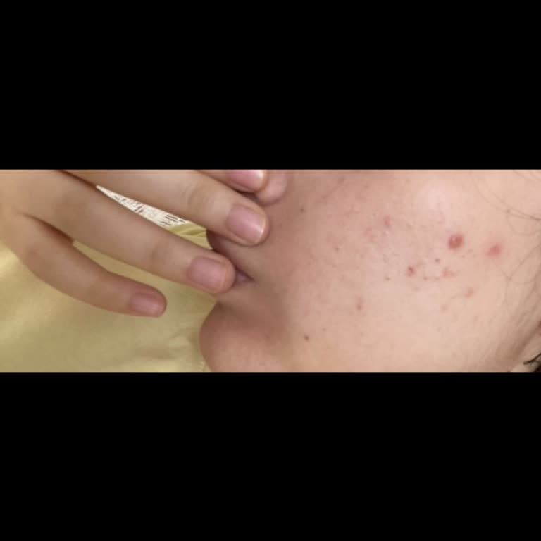 Cilt Bakımı Sonrası Kalıcı İzler Ve Yetersiz Çözüm Teklifiyle Mağduriyet Yaşadım