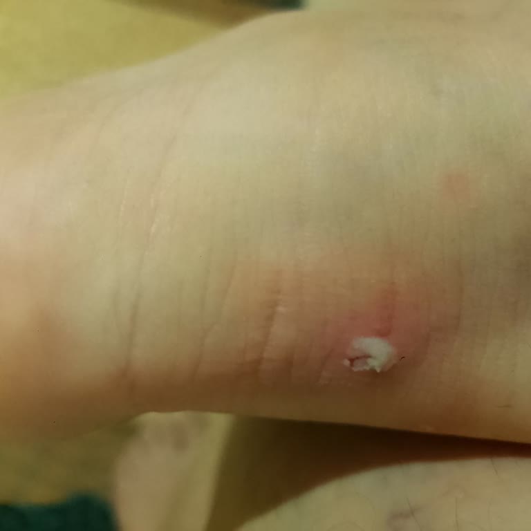 Reebok Ayakkabı Topuğumu Aşındırıyor Çözüm Bulamıyorum