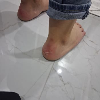 Elle Marka Botun Kısa Sürede Ciddi Sağlık Sorununa Yol Açması