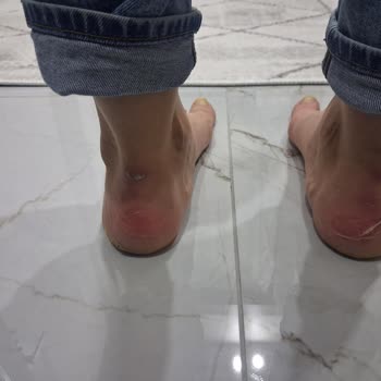 Elle Marka Botun Kısa Sürede Ciddi Sağlık Sorununa Yol Açması