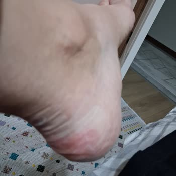 Elle Marka Botun Kısa Sürede Ciddi Sağlık Sorununa Yol Açması