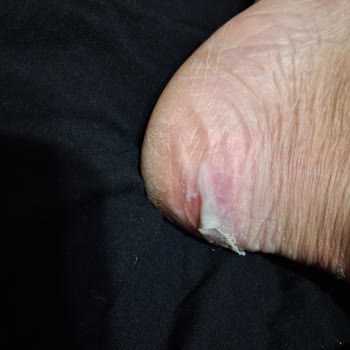 Elle Marka Botun Kısa Sürede Ciddi Sağlık Sorununa Yol Açması