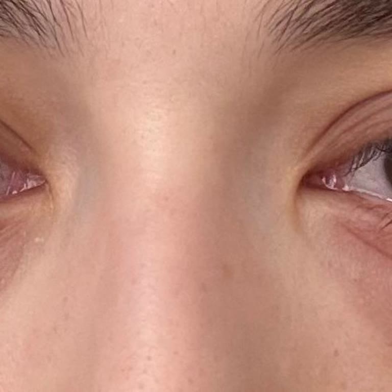 Makyaj Temizleme Suyu Gözlerimde Enfeksiyona Ve Şişmeye Sebep Oldu