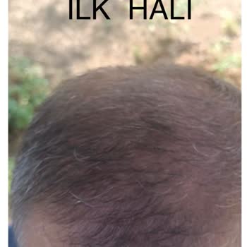 Medoran Fizik Tedavi Saç Ekimi Sonrası Başarısız Sonuç Ve İletişimsizlik Mağduriyeti