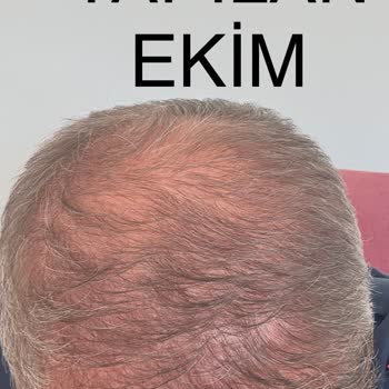 Medoran Fizik Tedavi Saç Ekimi Sonrası Başarısız Sonuç Ve İletişimsizlik Mağduriyeti