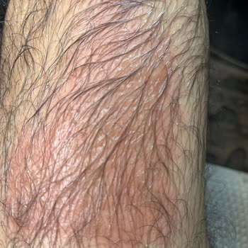 Tamirden Sonra Tekrarlayan Arıza Ve Ciddi Yanık Mağduriyeti