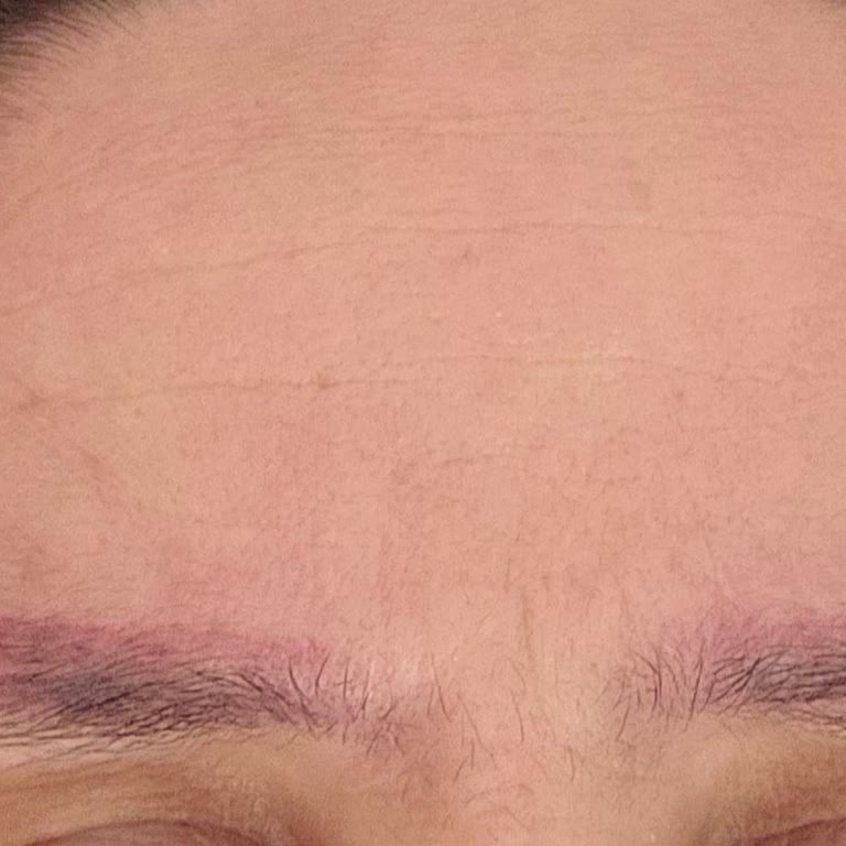 Kaş İşlemi Sonrası Renk Değişimi Ve Maddi-Manevi Mağduriyet