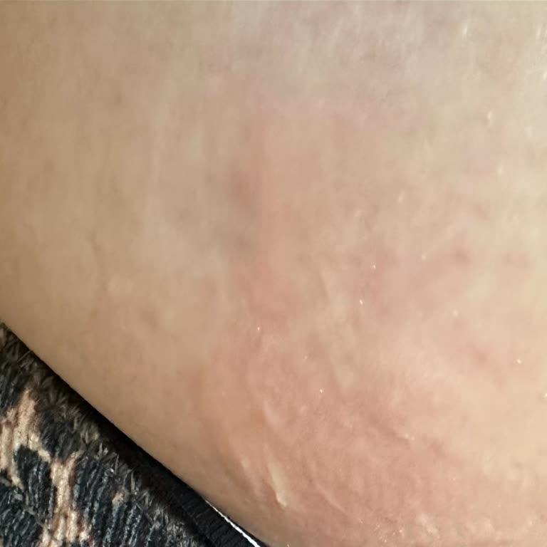 Stopever Isıtıcı Pedi Cildimi Ciddi Şekilde Yaktı Güvenim Sarsıldı