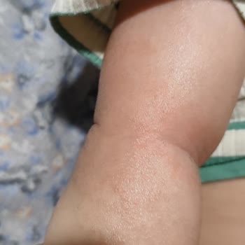 Mustela Krem Ve Şampuan Sonrası Bebeğimde Cilt Sorunları Oluştu