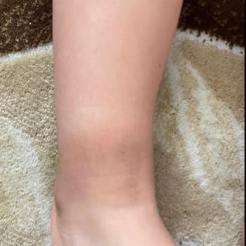 Çocuğumun Ayağında Yaraya Sebep Olan Ayakkabı İçin İade Talebim Reddedildi