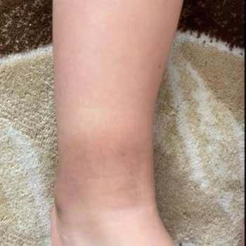 Çocuğumun Ayağında Yaraya Sebep Olan Ayakkabı İçin İade Talebim Reddedildi