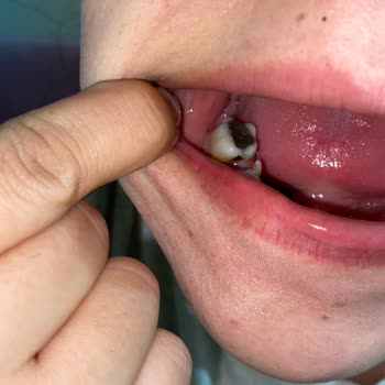 Hazır Çikolatadan Çıkan Ceviz Kabuğu Dişimi Kırdı, Sağlık Masraflarım Karşılanmalı