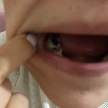 Hazır Çikolatadan Çıkan Ceviz Kabuğu Dişimi Kırdı, Sağlık Masraflarım Karşılanmalı