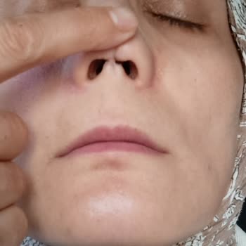 Başarısız Burun Ameliyatları Sonucu Sağlık Ve Psikolojik Sorunlar Yaşadım