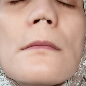 Başarısız Burun Ameliyatları Sonucu Sağlık Ve Psikolojik Sorunlar Yaşadım