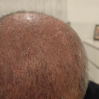 Saç Ekimi Sonuçsuz Kaldı, Merkezden Geri Dönüş Alınamıyor